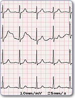 ECG